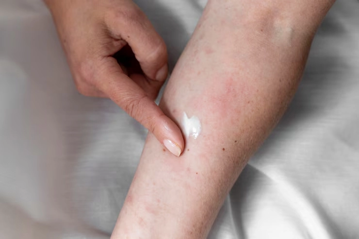 Psoriasis Action Plans