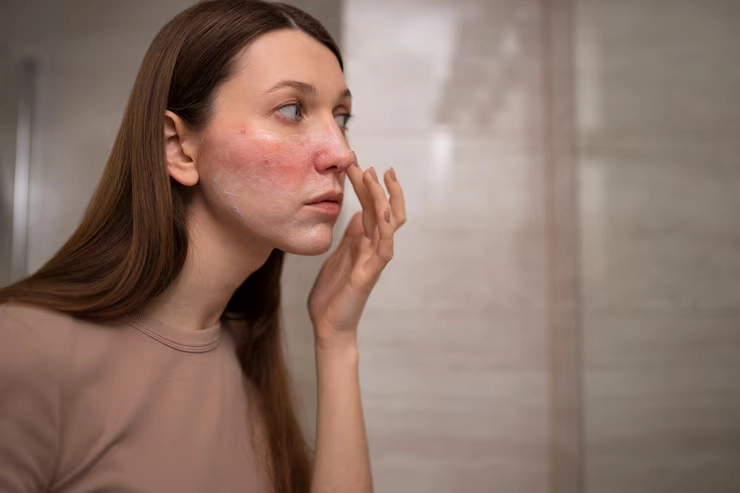 Rosacea Stabilisation